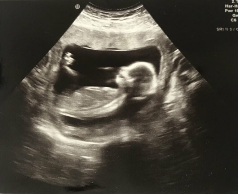 Schwangerschaft – die ersten 3 Monate